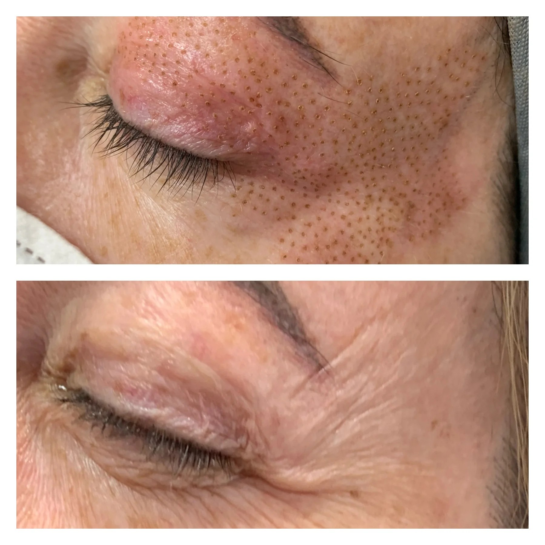 fibroblast treatment
